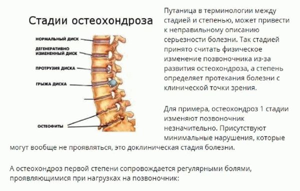 Допустимость службы в армии с остеохондрозом