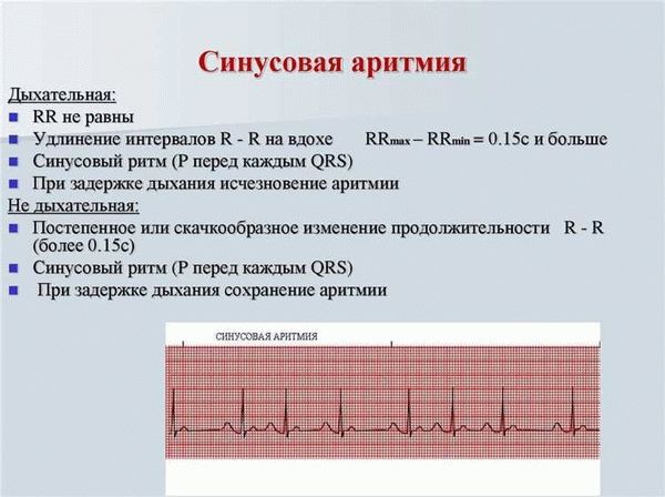 Как правило, если синусовая аритмия без сопутствующих заболеваний и функциональное состояние сердца находятся в пределах нормы, призывник считается годным для военной службы. Однако, при проведении медицинского осмотра специалисты обязательно принимают во внимание и другие факторы, которые могут оказать влияние на пригодность призывника с синусовой аритмией.