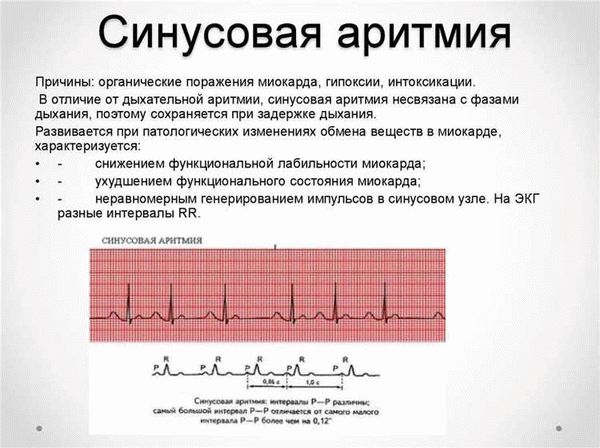 Категории пригодности при аритмии зависят от конкретных характеристик заболевания, сопутствующих патологиях и показателей сердечной активности. Основными критериями, ориентировочно применяемыми при определении категории призывника с синусовой аритмией, являются: стабильность сердечного ритма, наличие симптомов и ассоциированных заболеваний, функциональные возможности сердца и общее состояние здоровья призывника.